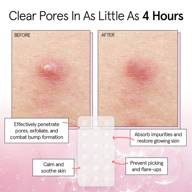 grace & stella Award Winning Invisible Spot Covers with Hydrocolloid (Round, 72 Count) - Spot Covers with Salicylic Acid and Tea Tree for Absorbing Impurities - Dermatologist Tested Skin Care, Cruelty Free, Vegan 🍁 All In One Marketplace Canada