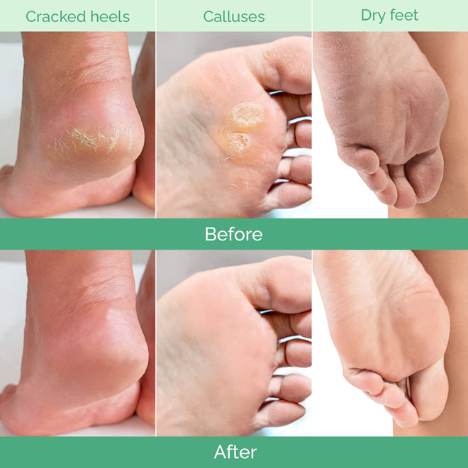 PLANTIFIQUE Foot Peel Mask Dermatologically Tested - 2 Pairs Peach Exfoliating Mask for Dry Cracked Feet - Masque Pied Peeling - Foot Care for Soft Baby Feet 🍁 All In One Marketplace Canada