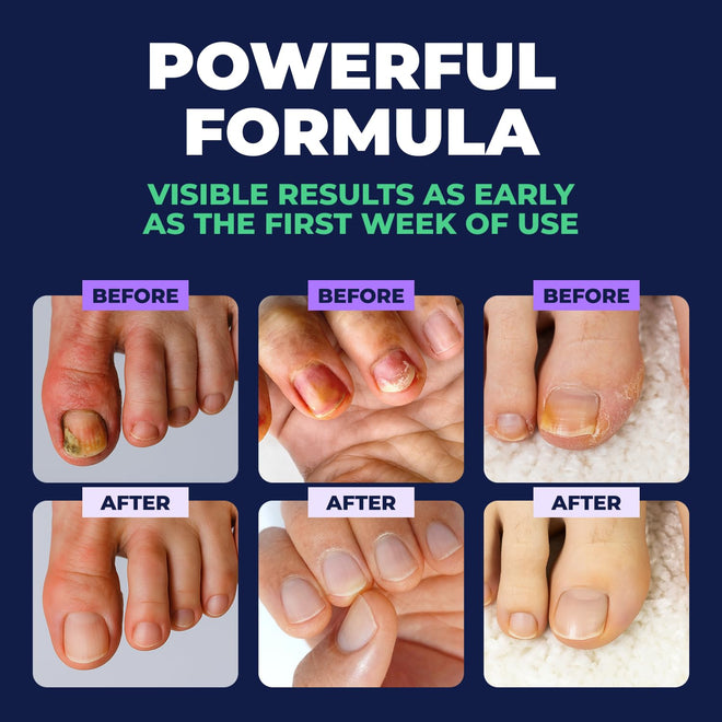 Orivelle Toenail Care Pen - Extra Strength Toe Nail Remedy - Professional Nail Solution for Fingernail with Tea Tree Oil (Pack of 4) 🍁 All In One Marketplace Canada