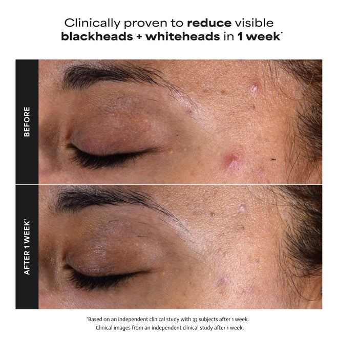 Paula's Choice SKIN PERFECTING 2% BHA Liquid Salicylic Acid Exfoliant, Daily Facial Exfoliator for Enlarged Pores, Wrinkles & Fine Lines, Fragrance-Free, Travel Size - 30 ml 🍁 All In One Marketplace Canada