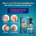 Tobcharm Nail Fungus Treatment for Toenails, Toe Nail Fungus Treatment, Nail Fungus Treatment, Toenail Fungus Treatment, Toe Fungus Treatment Extra Strength, Fungus Nail Killer, Nail Antifungal, Fungal Nail Treatment for Fingernails (30ml)
